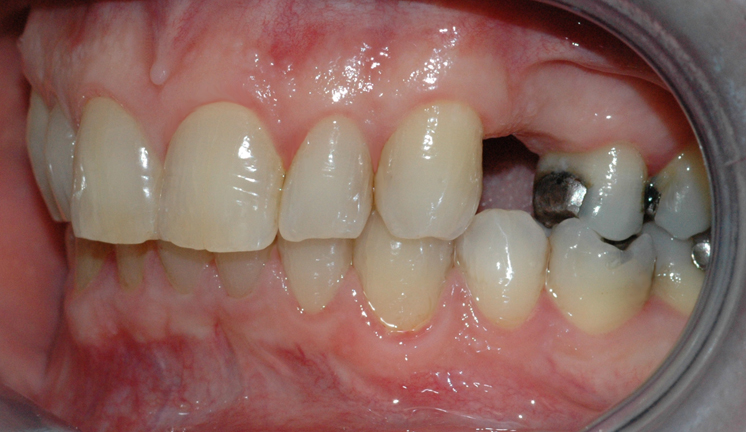 Bildet viser en manglende tann i overkjeven. Nabotennene har fyllinger og tilfellet egner seg derfor godt for brobehandling.