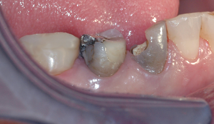 Bildet viser to tenner som er svært skadet. Tennene er svake, og ikke egnet for vanlig fyllingsterapi.