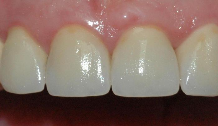 Bildet viser resultatet etter at tennene er reparert med keramiske kroner.