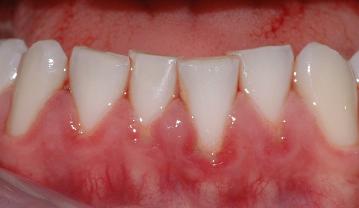 Bildet viser hvordan belegg har ført til rødt og hovent tannkjøtt ved flere tenner.
