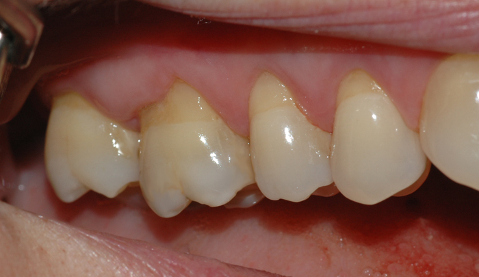 Bildet viser hvordan tannkjøttet over tid har trukket seg tilbake som følge av for hard tannbørsting