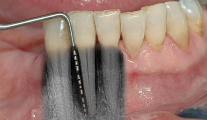 Bentapet bekreftes av et røntgenbilde – skaden er her så stor at tannen må tas bort.