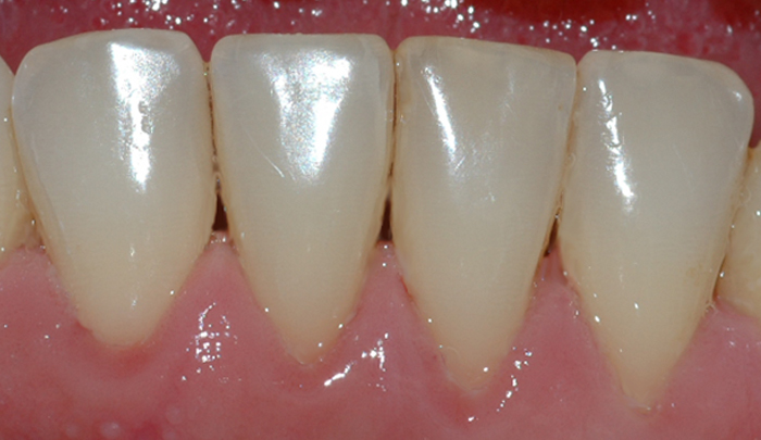Bildet viser forholdene i underkjeven etter at tannstein og misfarging er fjernet