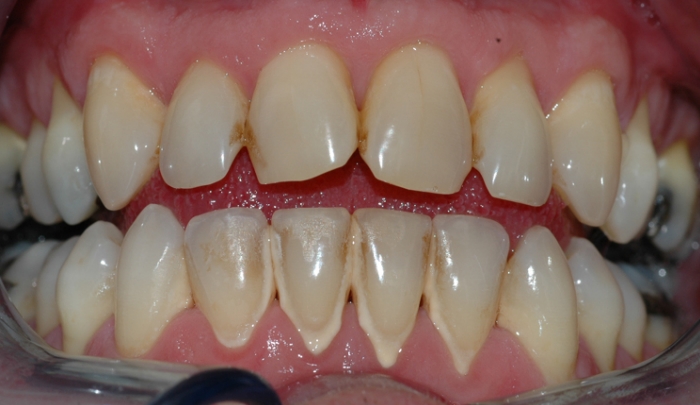 Her kan man se misfarging og tannsten på tennenes fremside.