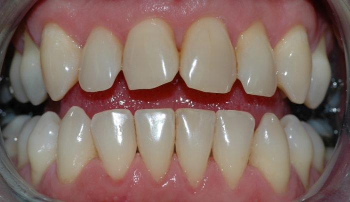 Etter puss og polering har tennene fått tilbake sin rene, glatte overflate.