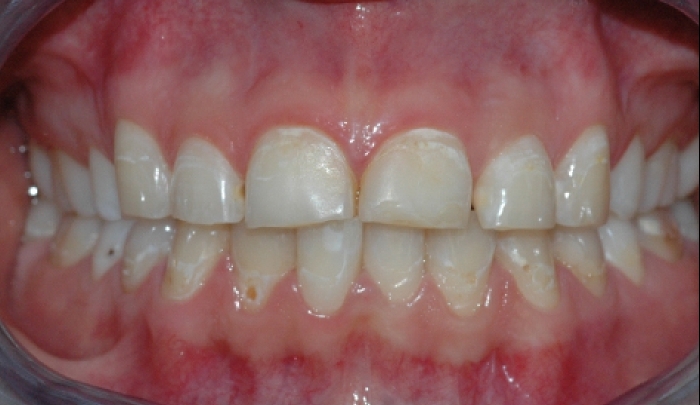 Bildet viser tenner som har vært utsatt for syrepåvirkning. 