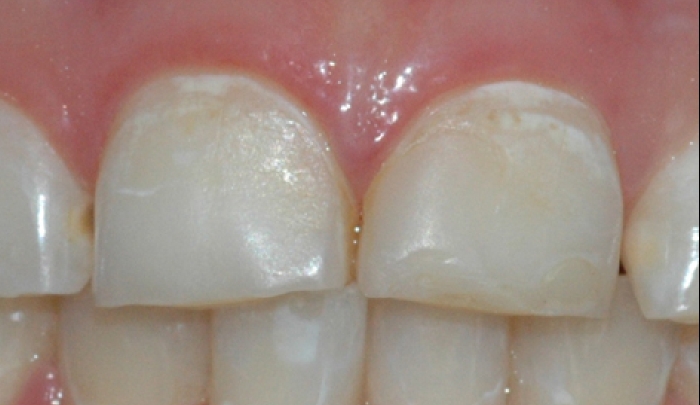 Et nærbilde viser at tennene har en matt overflate og områder med et gulere preg.
