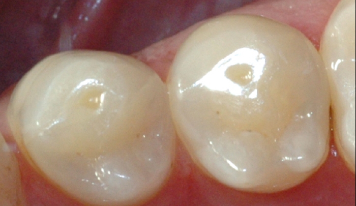 Bildet viser små groper i tennene, der emaljen er etset bort. 