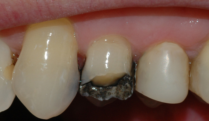 Bildet viser at en tyggeknute til en tann i overkjeven har frakturert. Tannen var svekket på grunn av en stor amalgamfylling. 