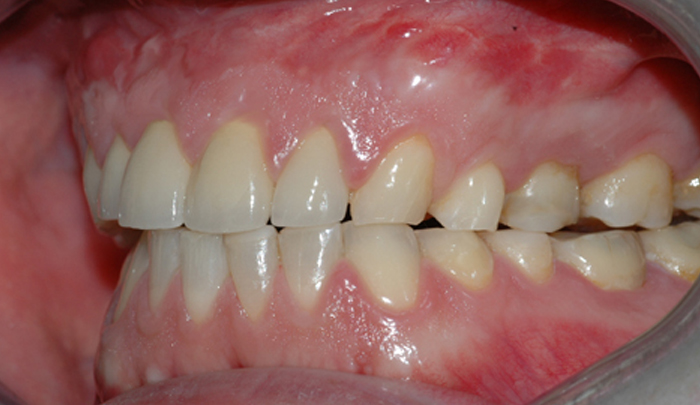 Bildet viser et eksempel på moderat tannslitasje som følge av tanngnissing. 