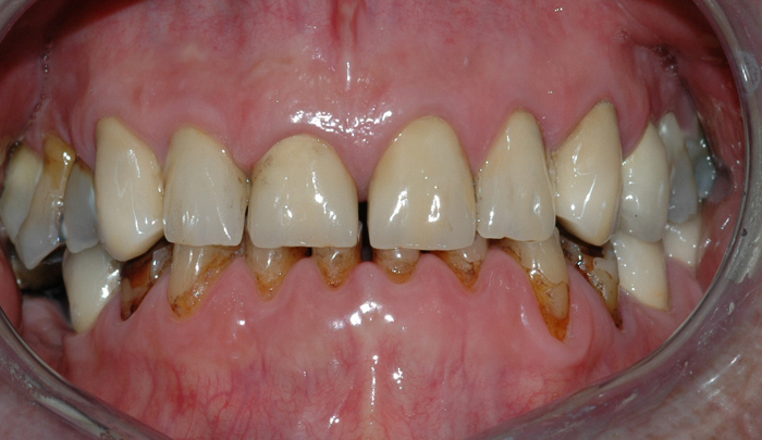 Bildet viser et eksempel på alvorlig tanngnissing. 