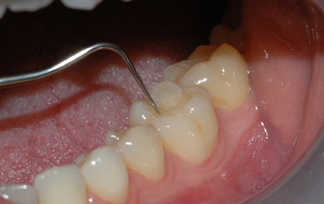 Tannlegen undersøker hver enkelt tann etter hull og skader.