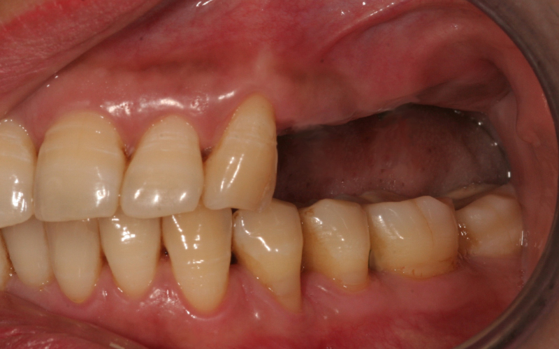 Bildet viser pasient med manglende tenner. Løsningen ble å lage en bro festet til implantater. 