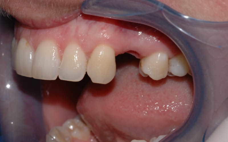 Bildet viser en pasient som mangler en tann i overkjeven. Ettersom nabotennene er uten fyllinger, egner tilfellet seg godt for implantatbehandling.