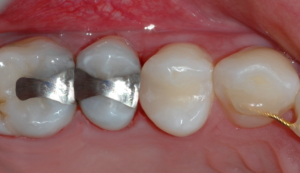 Bilde av tann etter fylling av hull er utført.