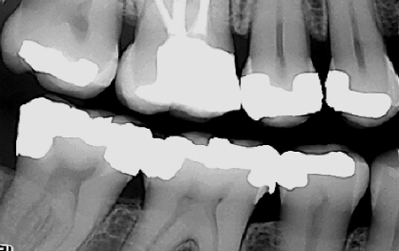 Ved en tannlegeundersøkelse kan røntgen avdekke fremtidige plager i god tid slik at vi får behandlet og iverksatt nødvendige tiltak før det blir et problem.
